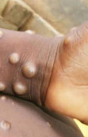 Screening protocol for Mpox at Bengaluru airport soon Screening protocol for Mpox at Bengaluru airport soon